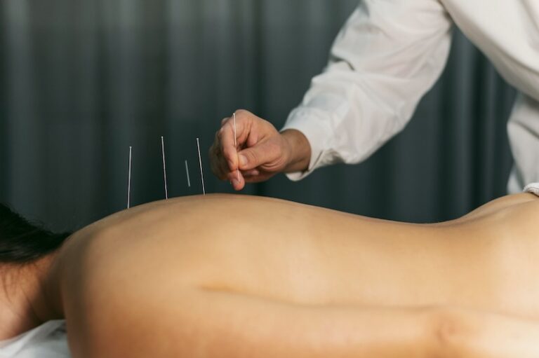 Benefits of Acupuncture in Spa Wellness