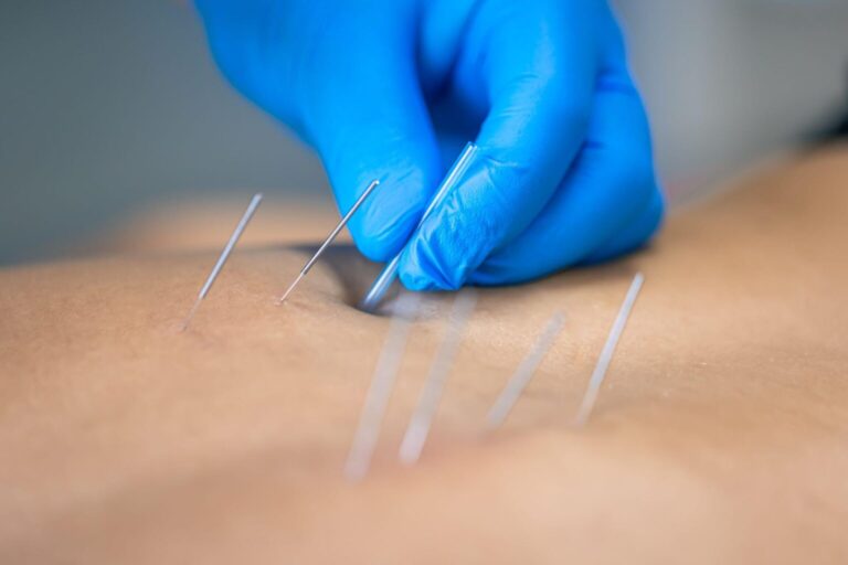 The Benefits of Acupuncture for Injury